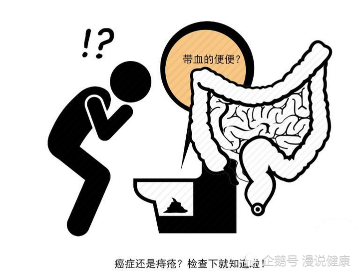 肠息肉癌变信号,多半在大便上?发现这3个"特征",尽快去医院
