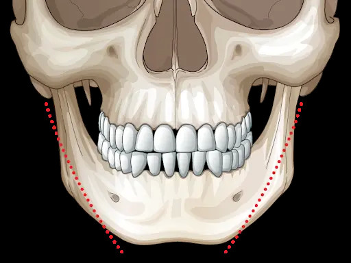案例分享一个下颌骨对颜值的影响有多大