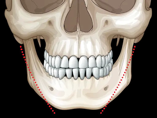 【案例分享】一个下颌骨,对颜值的影响有多大?