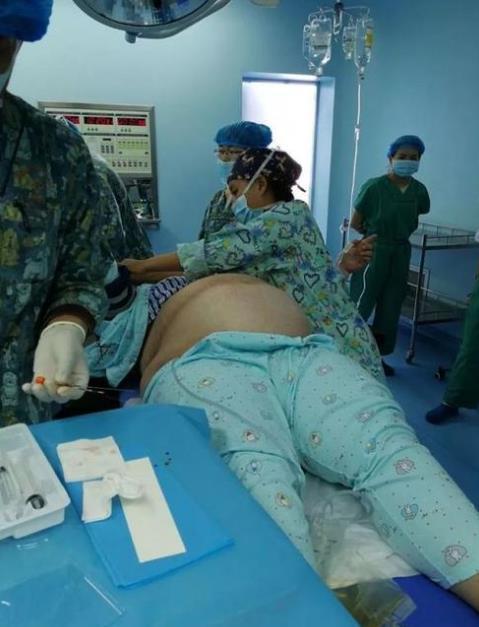 扒开层层脂肪才找到胎儿的头最胖产妇生孩子医生体力活