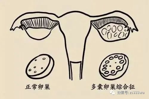 多囊卵巢患者怀孕注意事项!