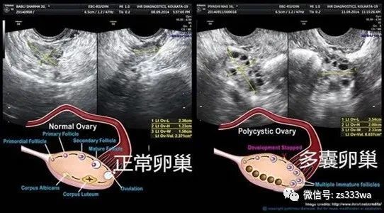 多囊卵巢备孕‖多囊卵巢怎么治疗最好,给多囊卵巢综合症患者饮食建议!