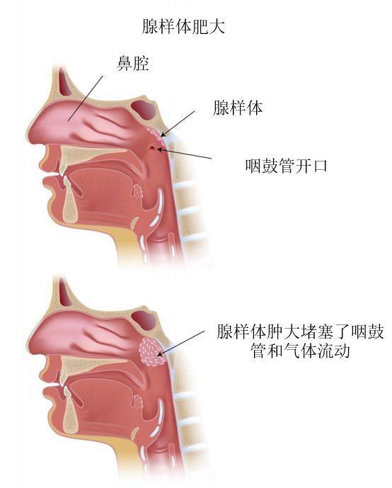 腺样体肥大有哪些症状?