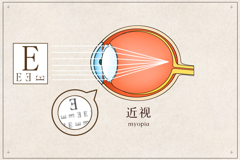 近视手术真的安全吗?眼科医生揭露其中的4个『秘密』