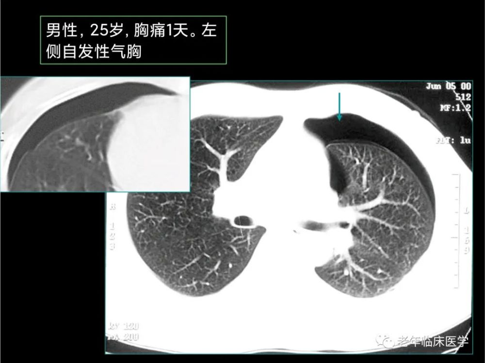 珍藏版(ct系列之十一):胸膜疾病