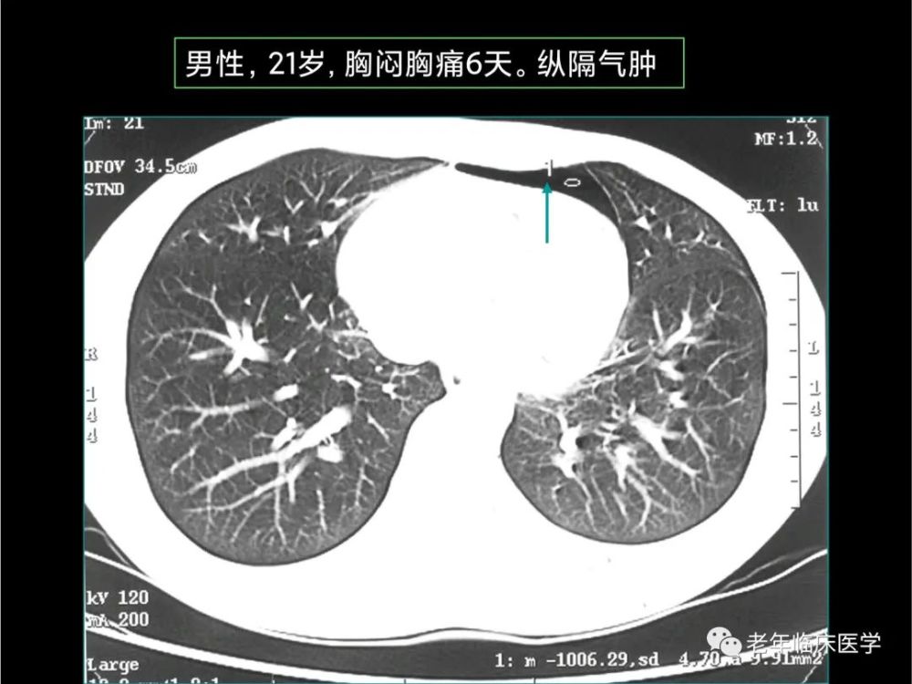 珍藏版(ct系列之十一):胸膜疾病