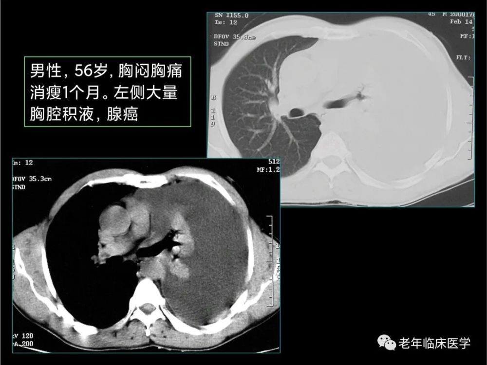 珍藏版(ct系列之十一):胸膜疾病