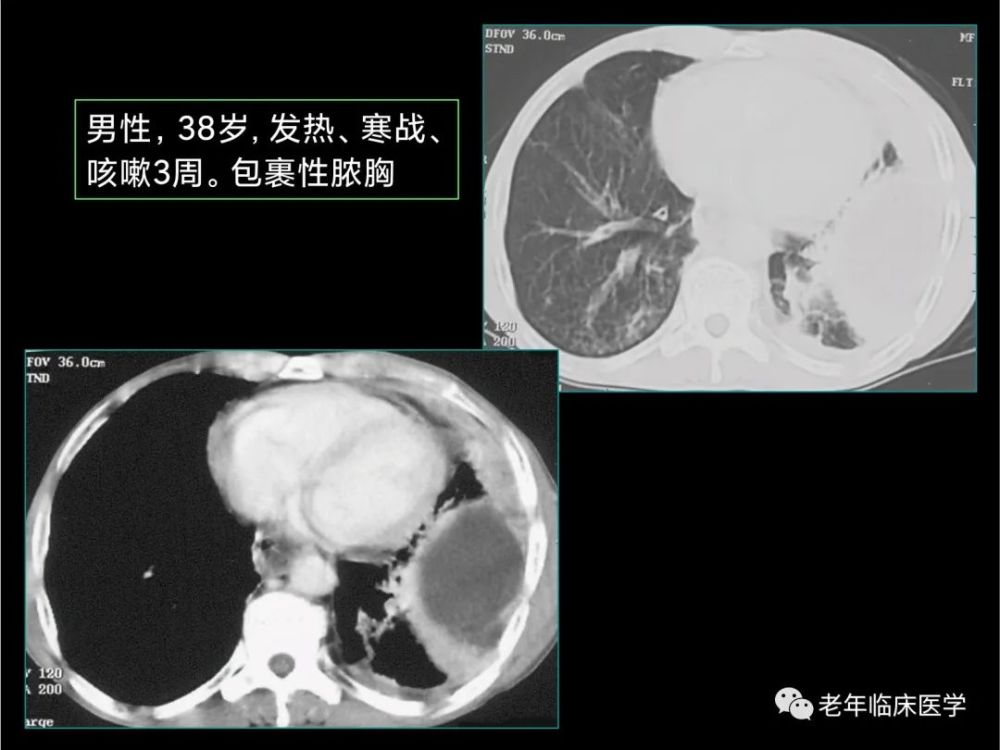 珍藏版(ct系列之十一):胸膜疾病