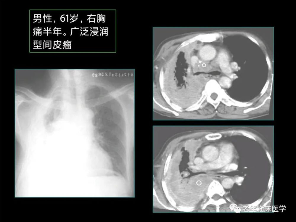 珍藏版(ct系列之十一):胸膜疾病