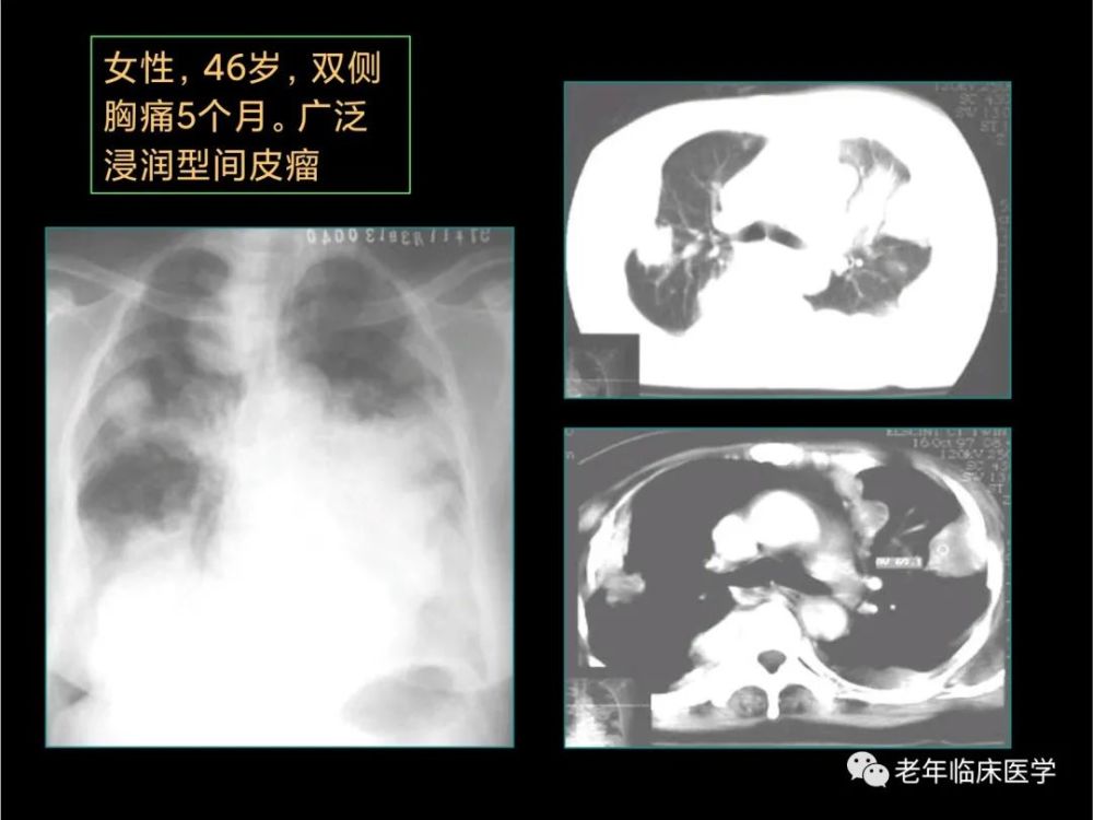 珍藏版(ct系列之十一):胸膜疾病