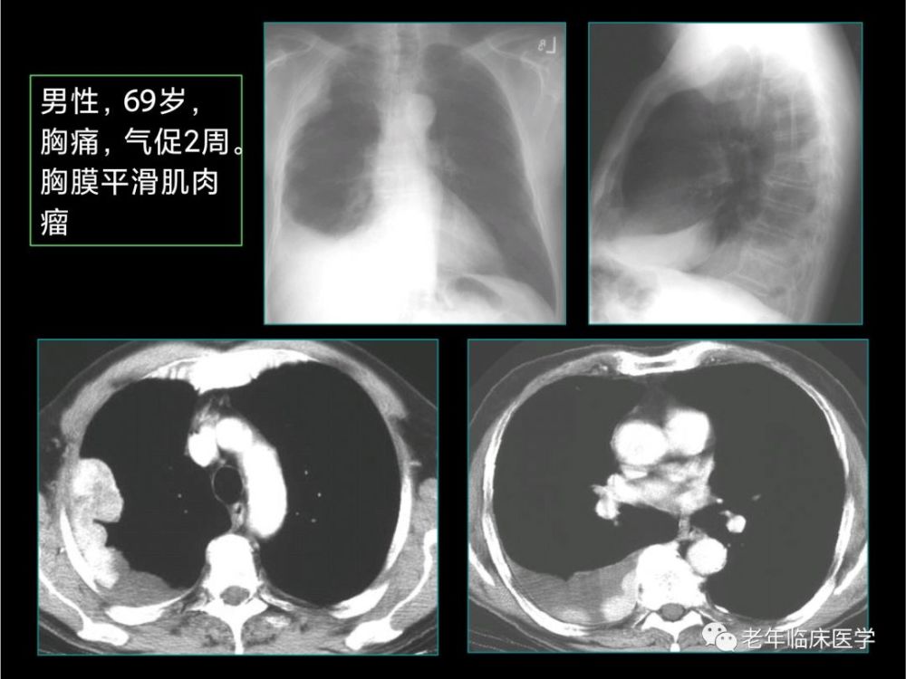 珍藏版(ct系列之十一):胸膜疾病