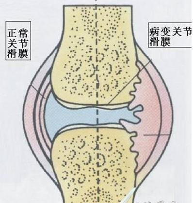 如何预防类风湿性关节炎的关节变形?专家提醒:注意病情发展.