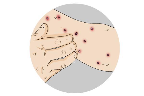 内皮肤上突然出现了很多小红点,是怎么回事?和肝病有关系吗?