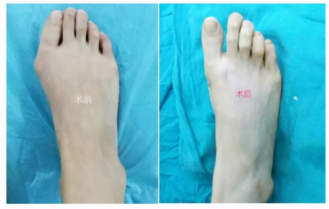 选择成都保髋医院拇外翻矫形中心值得吗?拇外翻手术关心那些事
