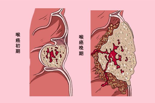 喉癌上门前,身体可能发出3个信号,医生:容易和慢性咽炎混淆