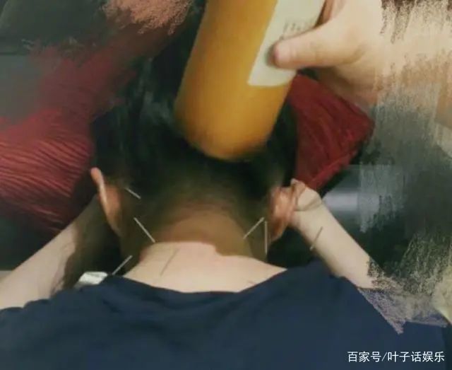 34岁刘亦菲旧病复发,深夜晒针灸照:希望尽快做回一条好汉