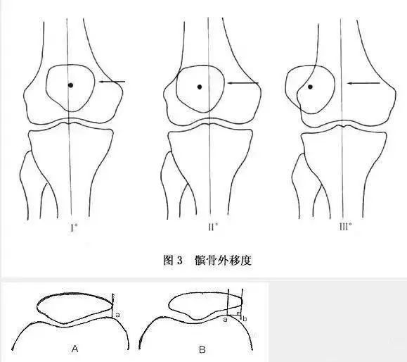 髌骨内侧支持带松弛,髌骨外侧支持带挛缩等异常,都会导致髌股关节不稳