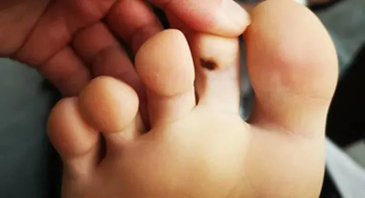 女,9岁,右脚趾头一颗不规则形状的痣.