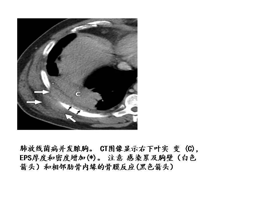 据报道,60%的肺炎胸腔积液或脓胸伴壁层胸膜增厚的患者中,在ct上胸膜