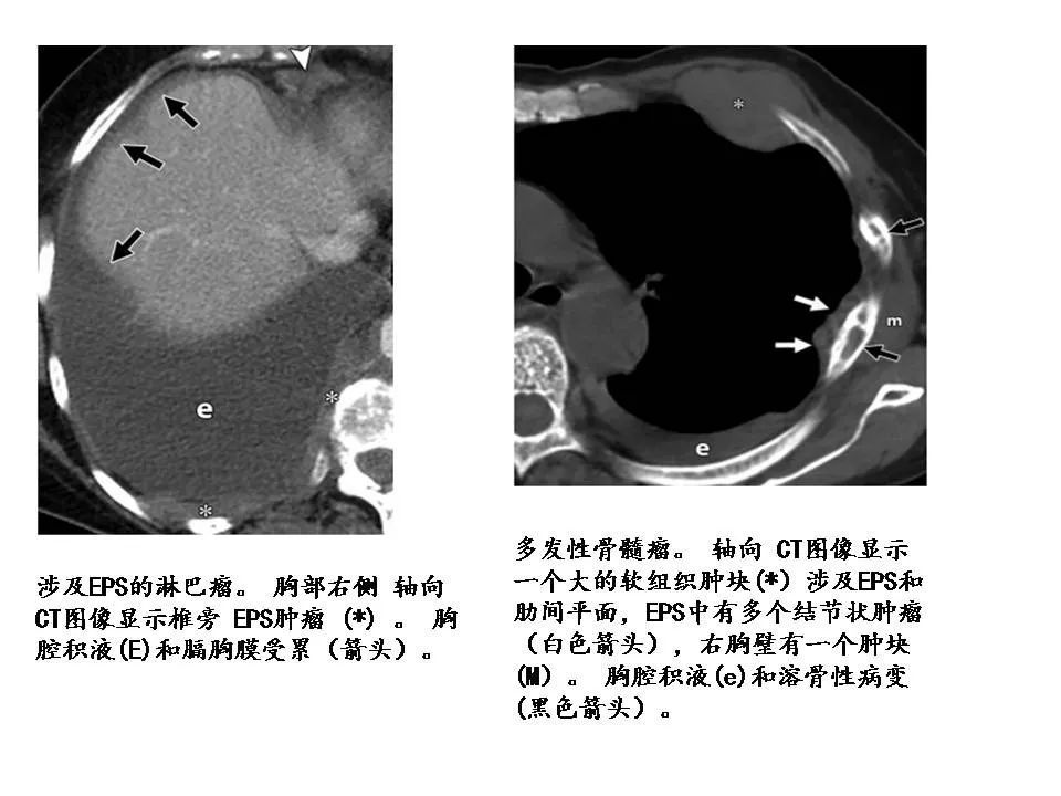 eps脂肪组织增厚和ct值增加见于胸膜周围的恶性肿瘤,主要是nsclc和