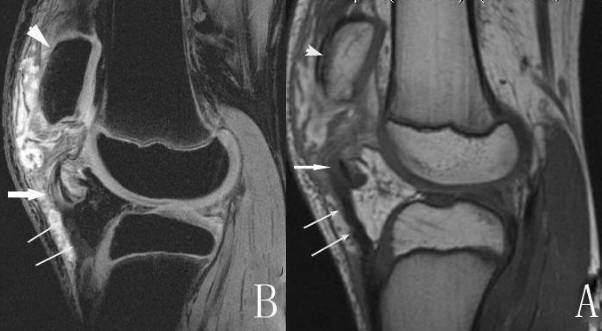 膝关节多种损伤mri表现合集
