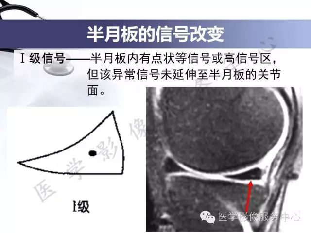 Ⅰ级损伤即早期退变或变性半月板损伤mri分为三级半月板损伤一
