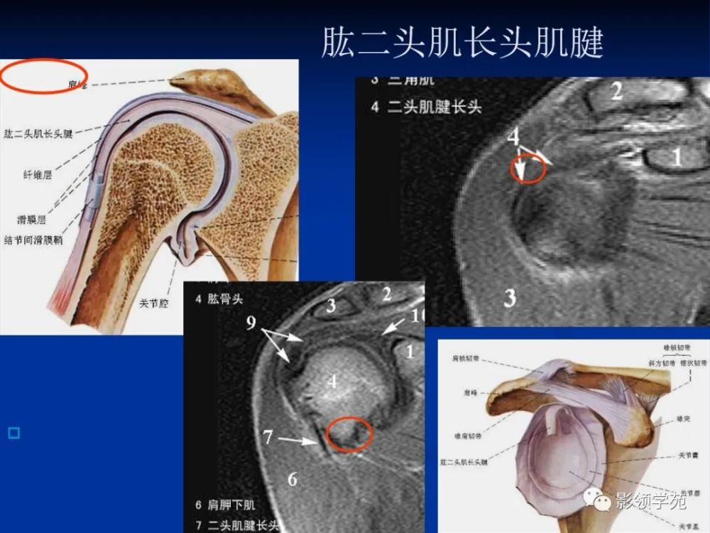 肩关节盂唇损伤的mri诊断