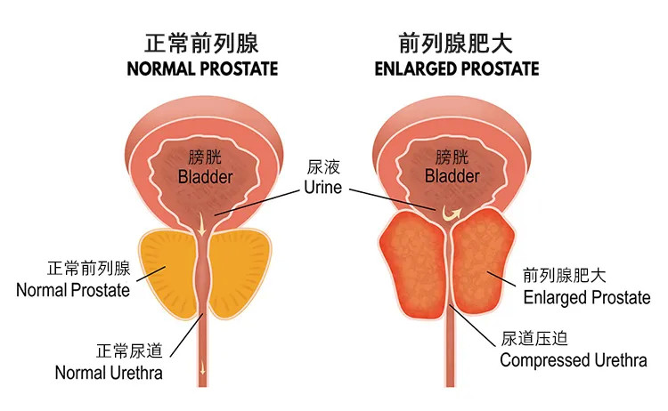 像剥橘子一样去除前列腺增生