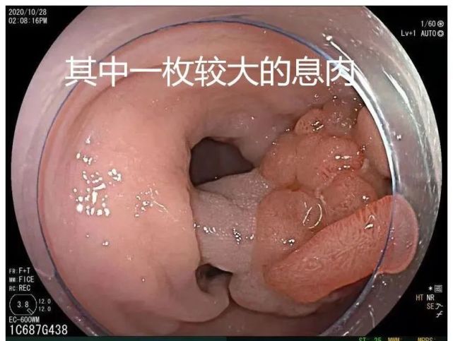 【金杏·关注】大多数肠癌都与它有关——你有肠道息肉吗?