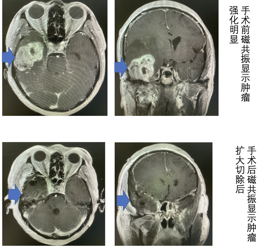 而对于三四级的高级别胶质瘤而言,扩大切除肿瘤的强化主体以及周围