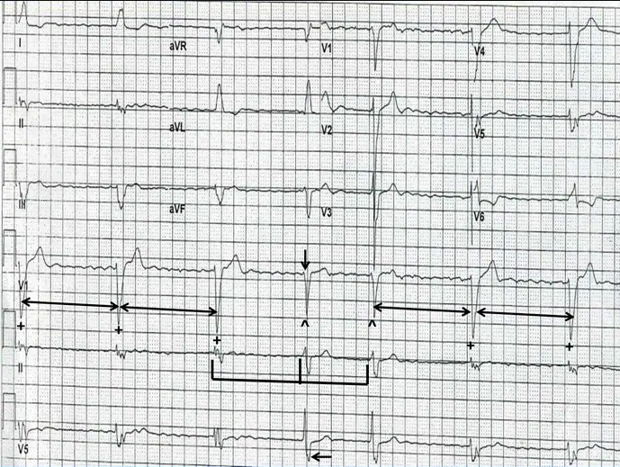 房颤患者突发头晕,呼吸困难,这个心电图你怎么看?