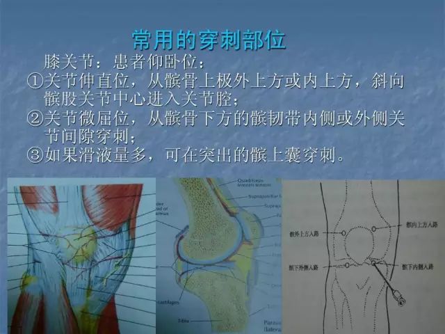 【实用技术】膝关节腔内注射治疗法!