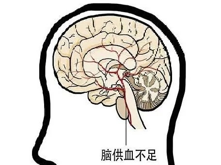 你是否也有脑供血不足?