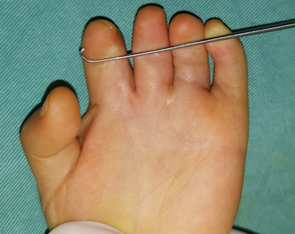 孩子手足畸形及意外创伤,如何治疗,重塑正常手足?