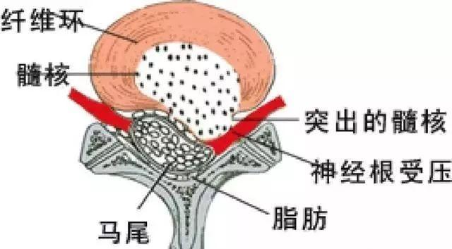 腰椎退行性病变的原因(一)