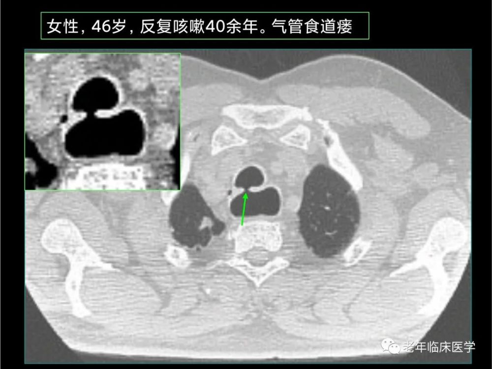 气道食管瘘ct表现可显示气管或者支气管与食管之间的小瘘道.