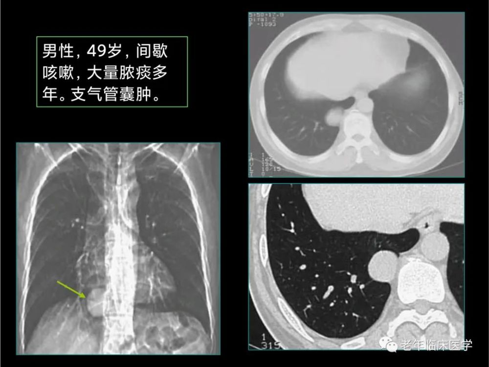 胺碘酮肺中毒ct表现以机化性肺炎最常见,特点为双侧病变,可呈磨玻璃