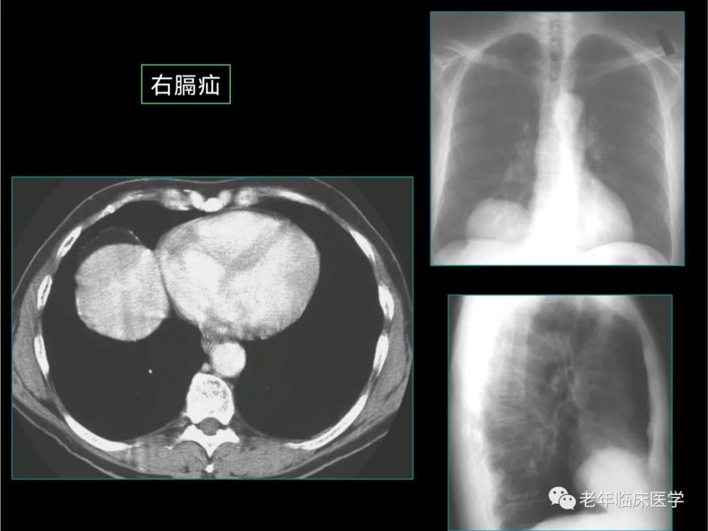 珍藏版ct系列之十三胸其他疾病ct表现