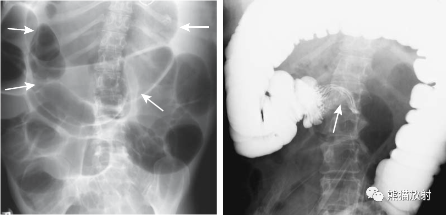 盲肠肠扭转. 盲肠明显扩张并移位至左侧(箭头).