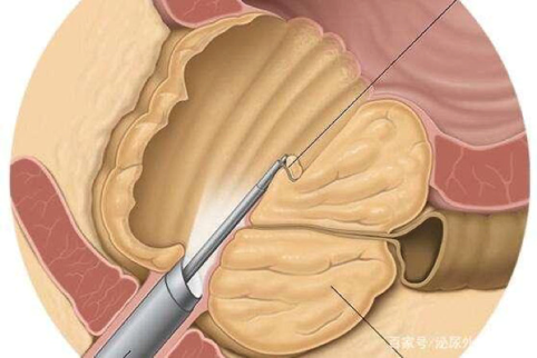 大泥鳅塞进肛门,能治前列腺增生?医生:万万使不得