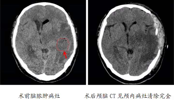 中耳炎可能导致颅内感染?烟台专家提醒:勿以病小而不医