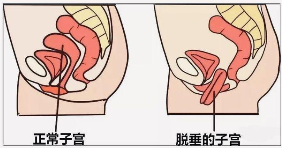 子宫脱垂是指子宫从正常的位置沿着女性阴道下降,严重的患者可能出现