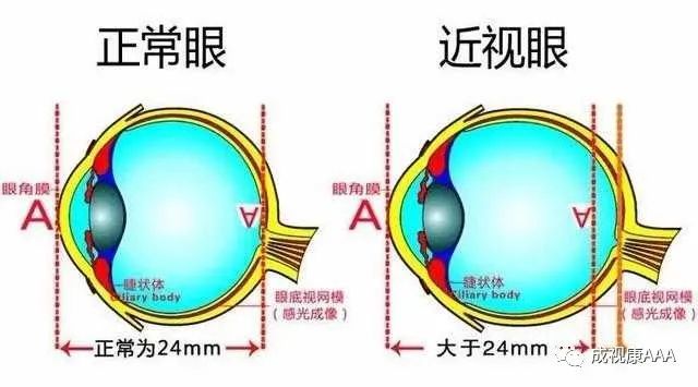 专家揭秘|6个关于孩子近视的真相,爸妈都应该知道,后悔没早看到