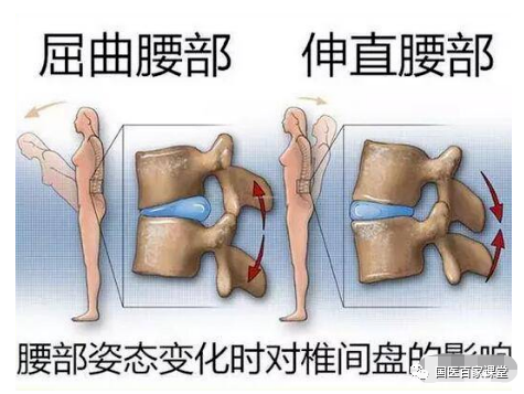 腰椎间盘突出症