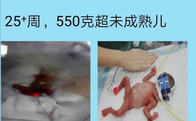 婴儿生下来只有550g 皮肤一碰就裂.在她手上,救回过很多这样的早产儿
