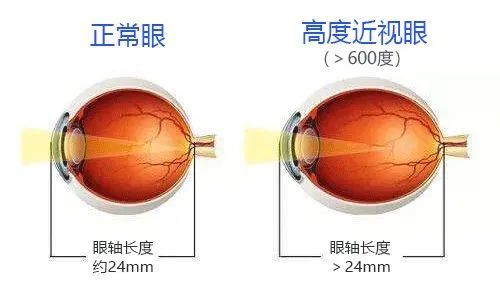 高度近视的六大危害,家长都知道吗?_腾讯新闻