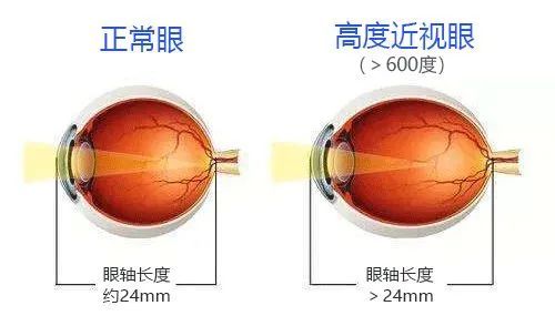 高度近视的六大危害,家长都知道吗?