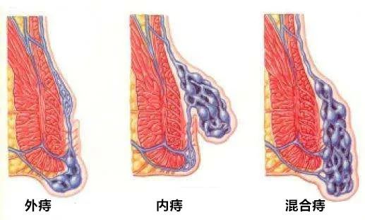 痔疮的形成和危害