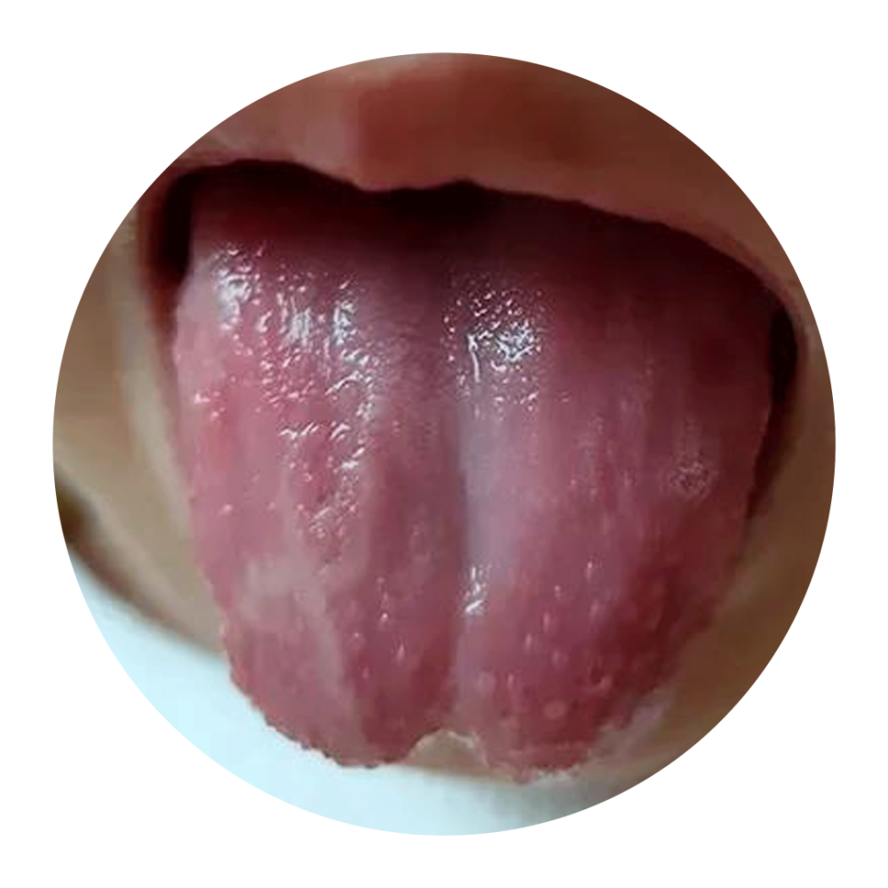 孩子的舌苔属于地图舌吗