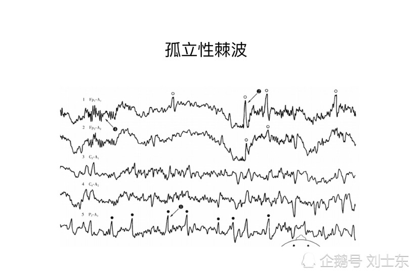 儿童脑电图基础与判读解析